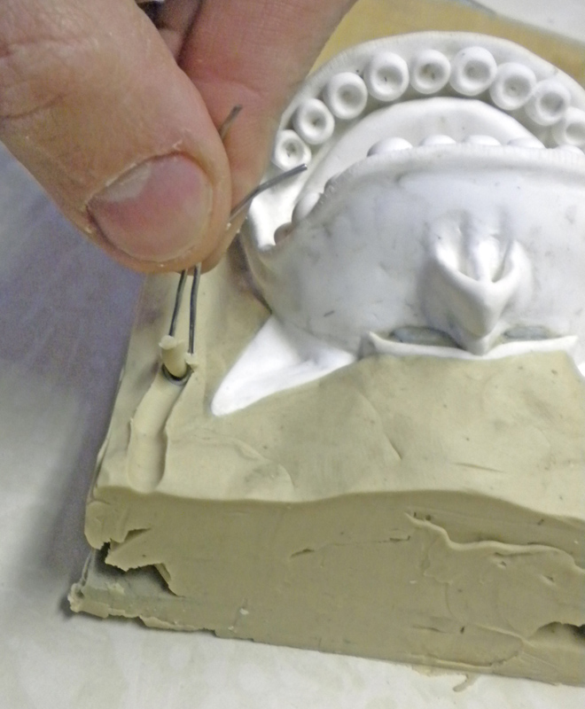 Main plaçant des repères métalliques sur un modèle entouré de pâte à modeler